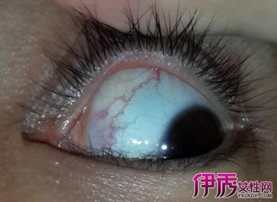 眼底发炎怎么治疗