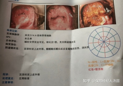 宫颈糜烂两度怎么治疗