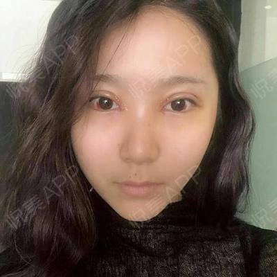 全切双眼皮拆线后注意事项