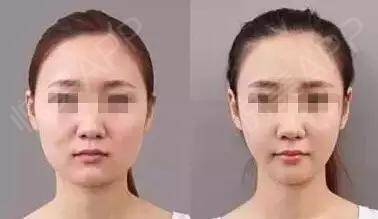 脸部吸脂费用是多少