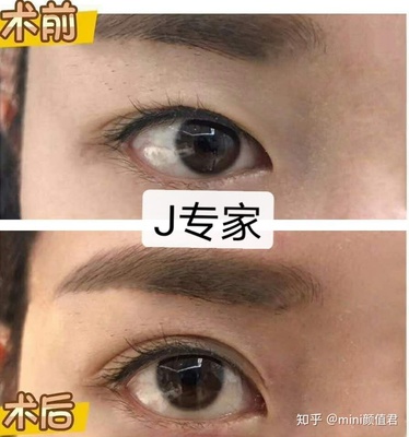 双眼皮 昆明