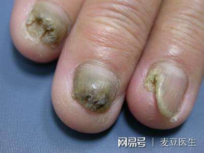 指甲上有黑纹是怎么回事