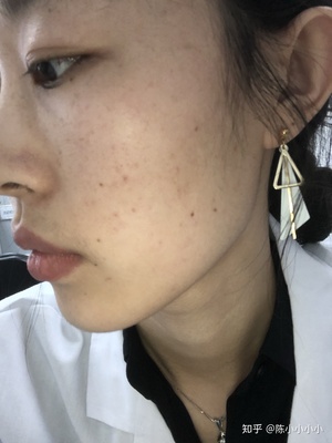 祛痣后的褐色印会消吗