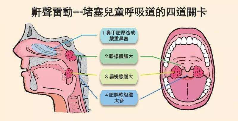 下鼻甲肥大怎么治疗