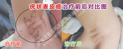 线状疣怎么治疗