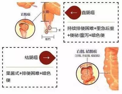 直肠癌便血量是多少