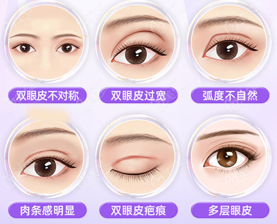 双眼皮做修复