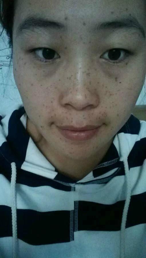长痘痘能吃什么油