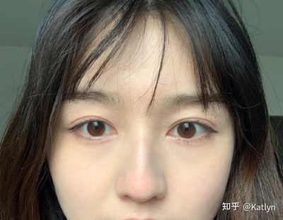 割了双眼皮后特后悔
