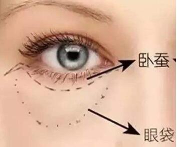 怎么治疗大眼袋