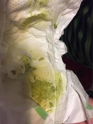 八个月宝宝拉绿屎