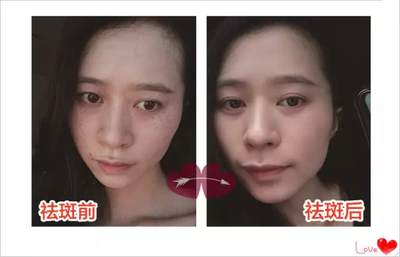 祛斑有什么副作用