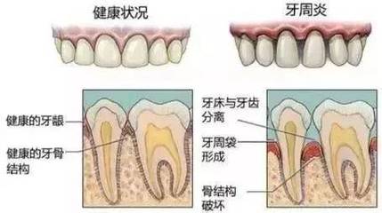 补牙后牙缝大了怎么办