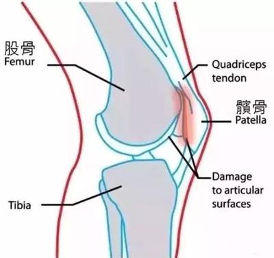 膝盖关节响是怎么回事