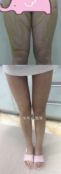 大腿抽脂三天后的照片