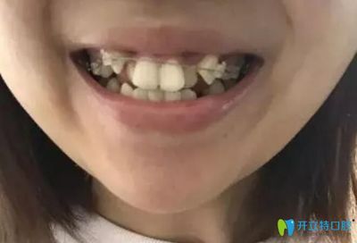 智齿酸痛是怎么回事