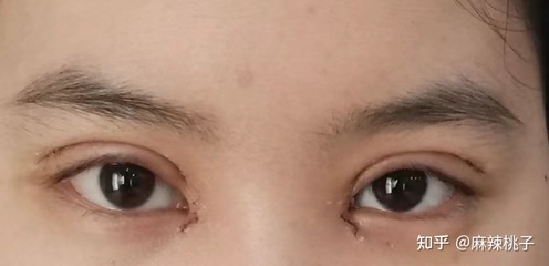 沈阳 双眼皮