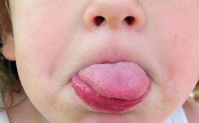 小孩舌头发白是怎么回事