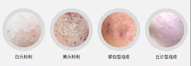 痘痘的脓不挤