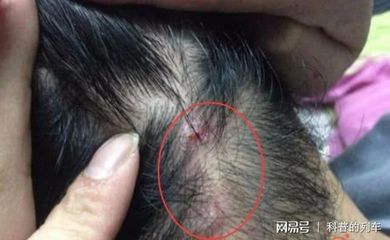 为什么上火会长痘痘