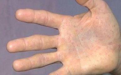 拍手掌可以治痘痘吗