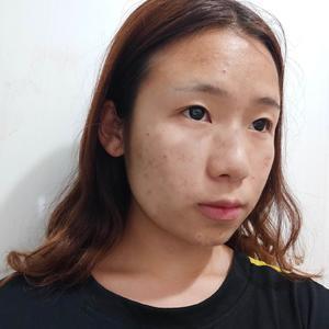 青春痘疤痕修复