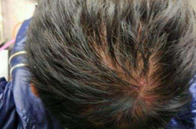 脸上身上头皮上长痘痘