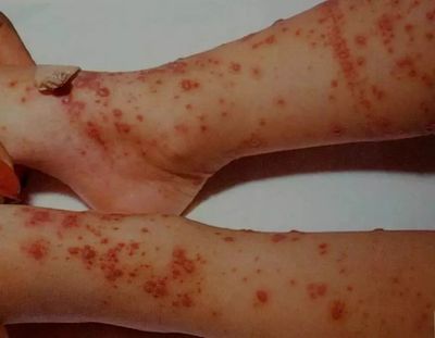 宝宝常见皮肤病图片