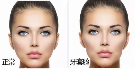 牙齿矫正失败后果