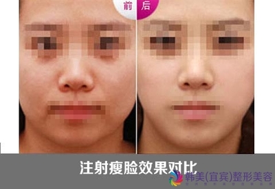 botox注射瘦脸效果