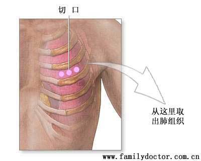 腋下手术要多少钱