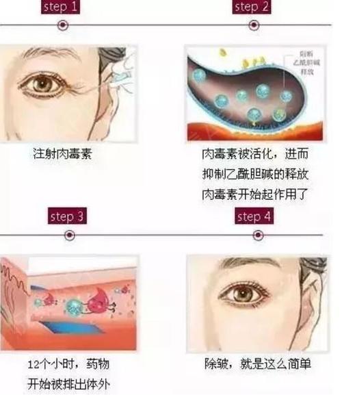 除皱原理