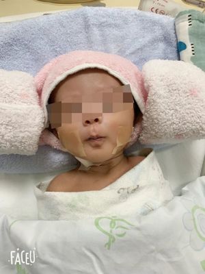 新生儿室间隔缺损