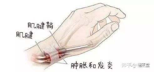 手腕转动疼是怎么回事