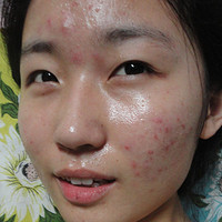 痘痘长完以后皮肤不规整