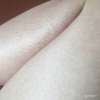 皮肤鱼鳞病怎么治疗