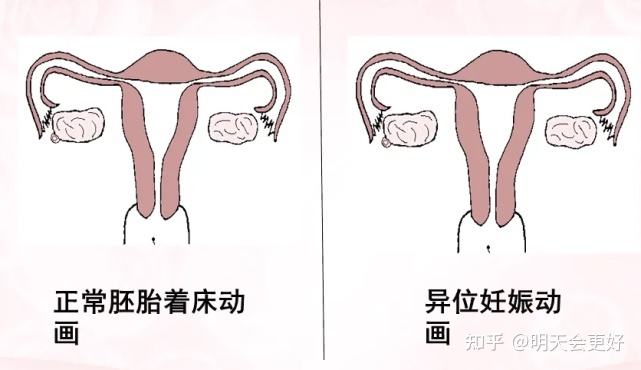 宫腔粘连会肚子疼吗