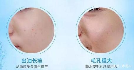 痘痘毛孔方向