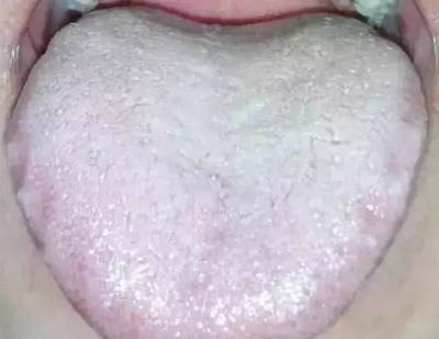 舌苔白厚腻是怎么回事