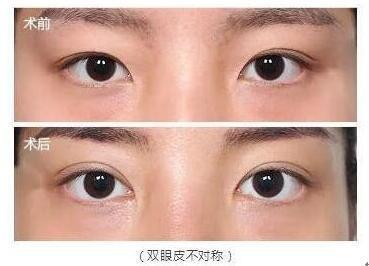 双眼皮的坏处