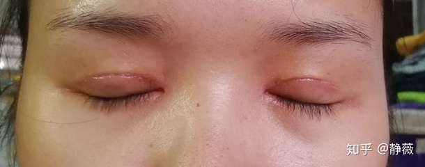 双眼皮结痂多久掉