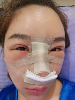 假体隆鼻眼睛周围肿了