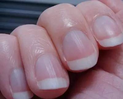孩子手指甲有竖纹是怎么回事