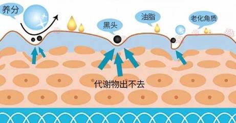 挤黑头毛孔粗大怎么办