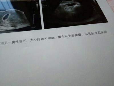 孕囊里没有胚芽是怎么回事