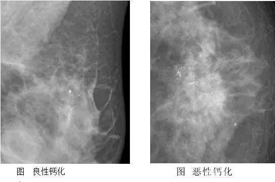 小叶增生切除多少钱