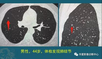 肺小结节会引起咳嗽吗