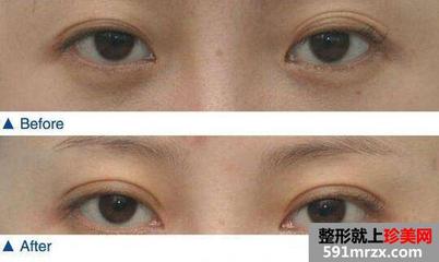 多层眼皮变双眼皮