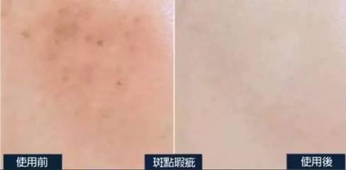素颜怎么遮痘痘
