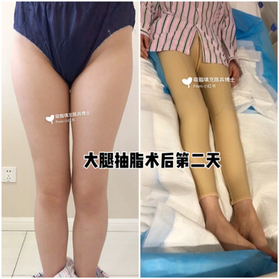 大腿抽脂三天后的照片